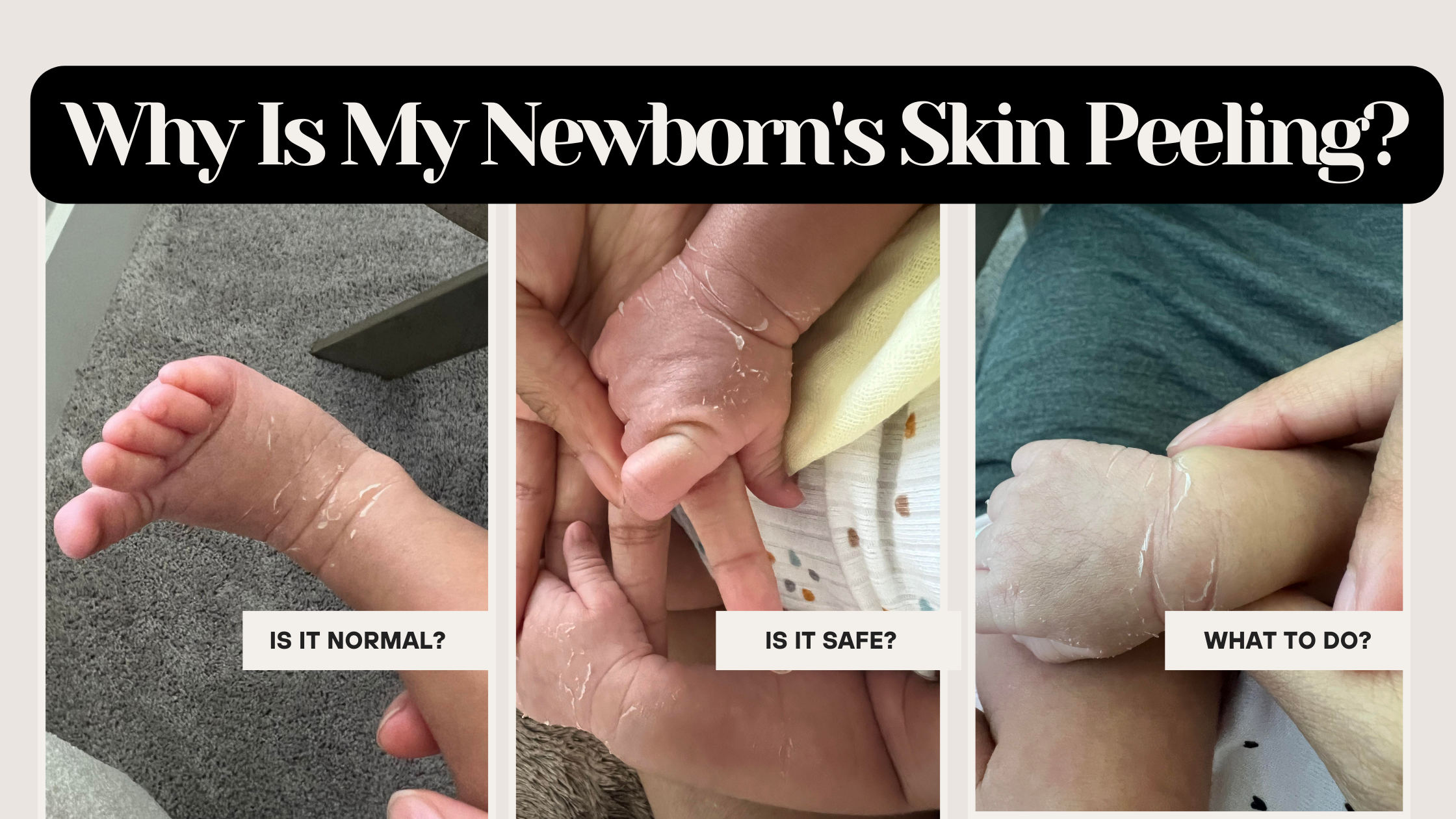 Infant peeling skin