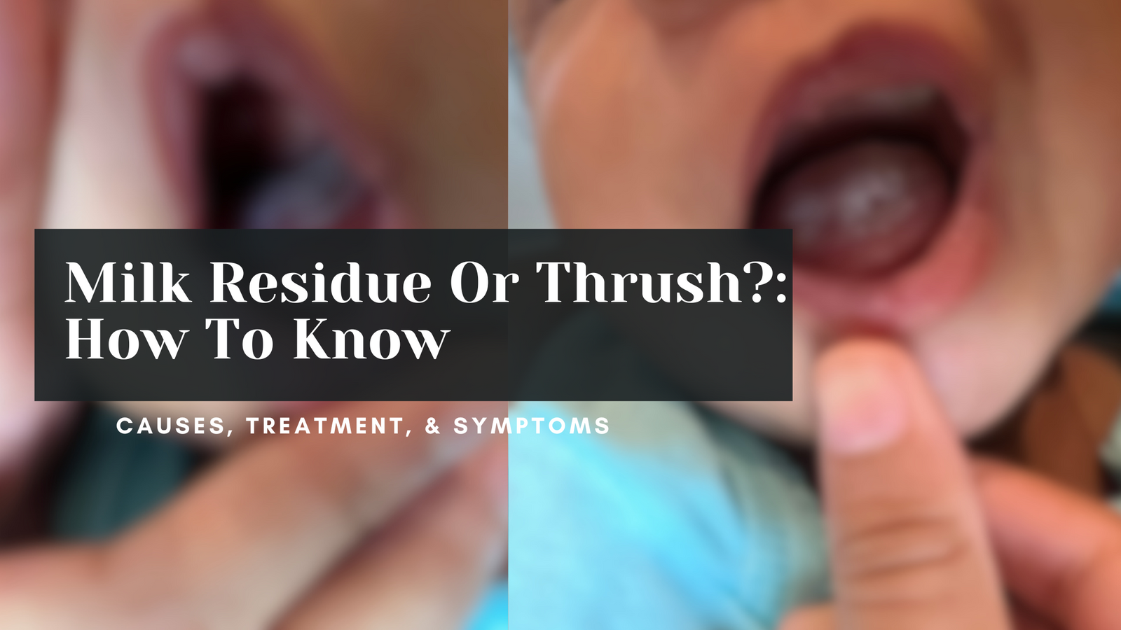 White On Babies Tongue: Thrush or Milk? How To Know.